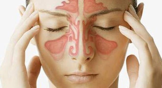 Đau họng khó nuốt nước bọt do viêm xoang mũi