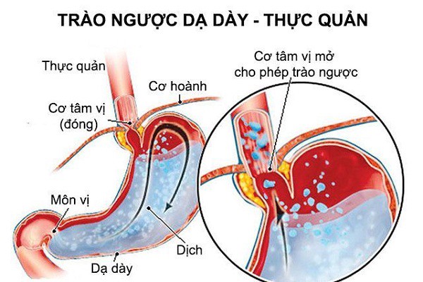 Đau họng khó nuốt nước bọt do trào ngược dạ dày thực quản