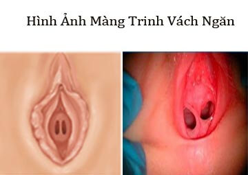 Màng trinh dạng vách ngăn