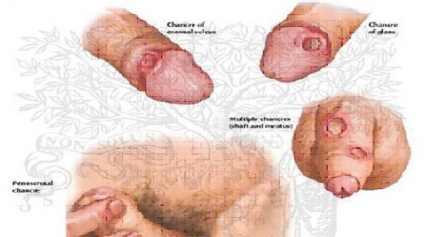 Bệnh giang mai là gì nguyên nhân, triệu chứng cách điều trị hiệu quả nhất