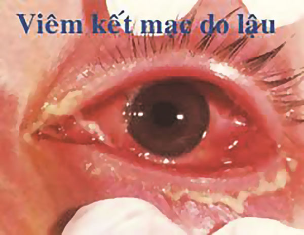 Bệnh lậu mắt có thể gây viêm mắt, lâu dần có thể dẫn tới mù lòa
