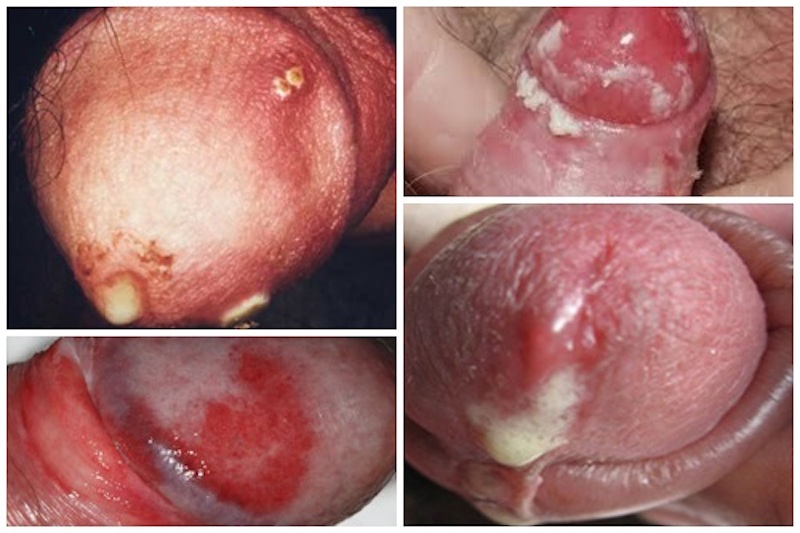 Dấu hiệu của bệnh lậu ở nam giới