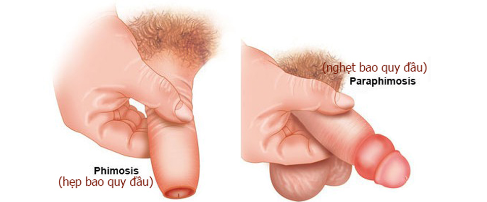 Hẹp bao quy đầu nguy hiểm như thế nào?