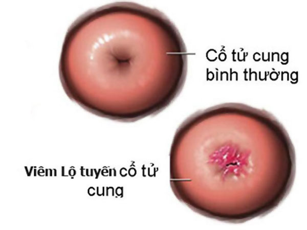 Viêm lộ tuyến cổ tử cung là gì?