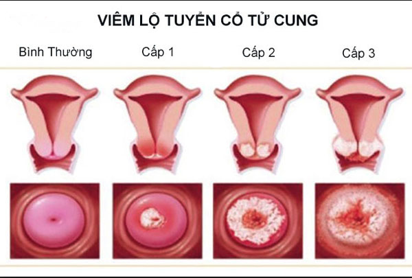 Nguyên nhân của viêm lộ tuyến cổ tử cung.