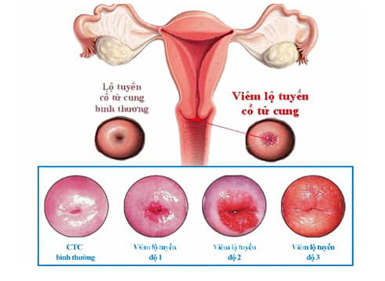 Chữa, đốt viêm lộ tuyến cổ tử cung bao nhiêu tiền ở đâu tốt nhất 2020
