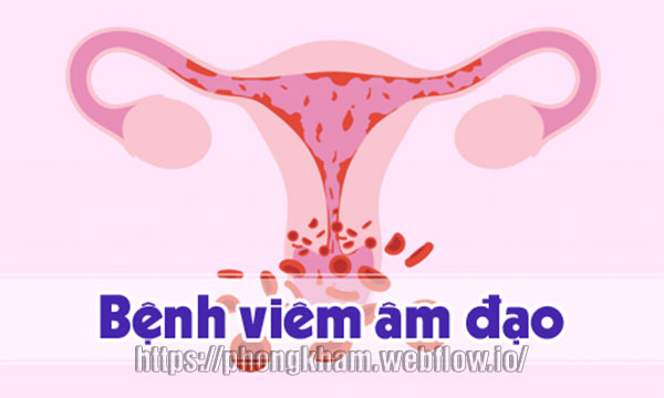Thuốc đặt chữa viêm âm đạo theo Đông y