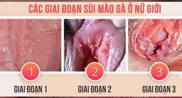 Cách điều trị hiệu quả bệnh sùi mào gà ở phụ nữ