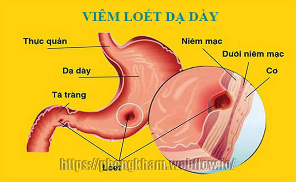 5 Cách chữa đau dạ dày hiệu quả