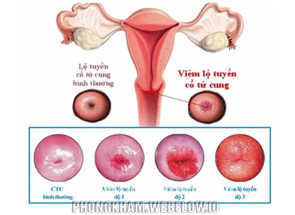 Chữa, đốt viêm lộ tuyến cổ tử cung ở đâu tốt nhất 2020