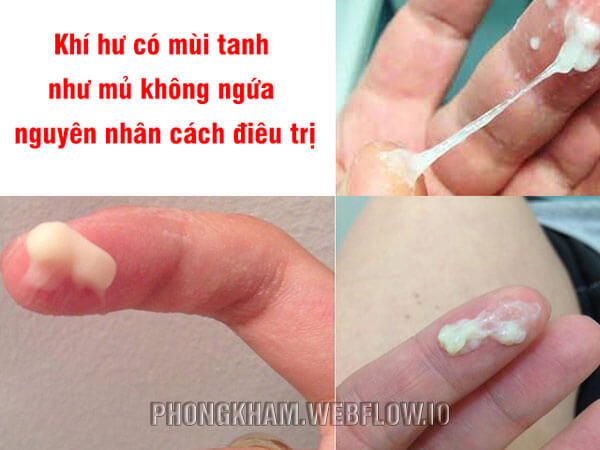 Cách điều trị khí hư có mùi tanh như mủ không ngứa