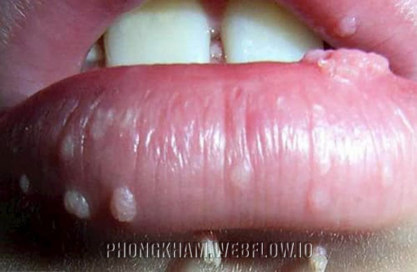 Triệu chứng sùi mào gà ở môi