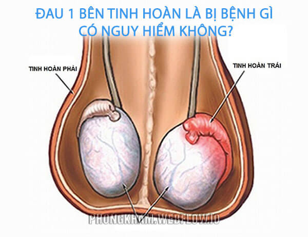 Đau 1 bên tinh hoàn là bị bệnh gì có nguy hiểm không?