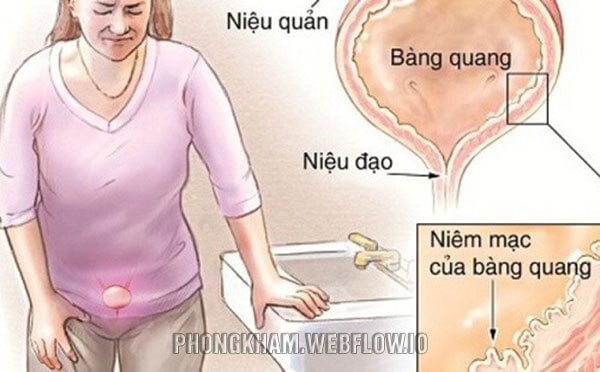 7 nguyên nhân của bệnh viêm bàng quang ở nam giới, nữ giới