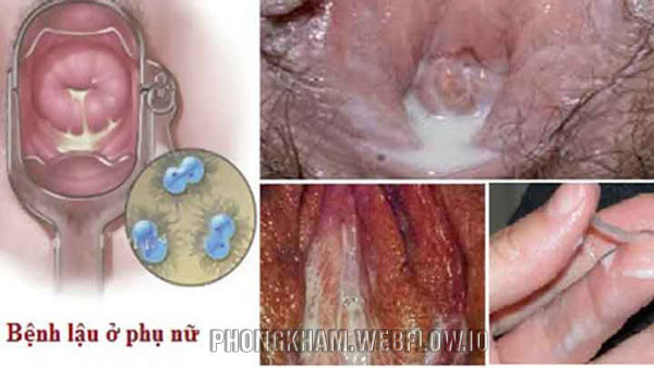 Hình ảnh bệnh lậu ở nữ giới