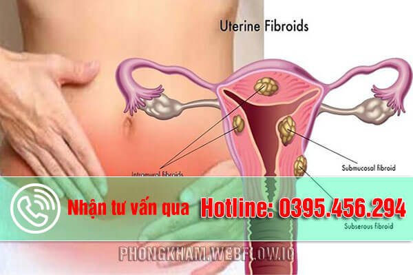 Triệu chứng của u xơ cổ tử cung
