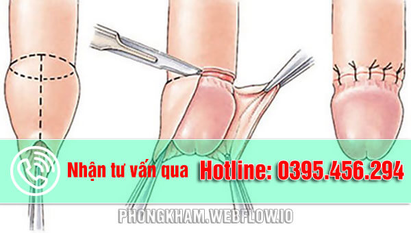 Cắt bao quy đầu tại Phòng khám đa khoa Hưng Thịnh