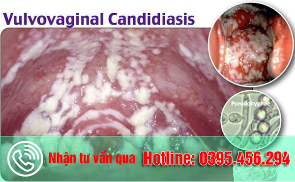 Viêm âm đạo do nấm chữa bằng cách nào?