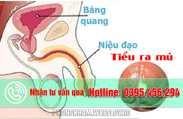 Tiểu ra mủ nguyên nhân cách điều trị tốt nhất