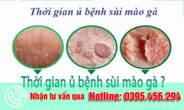 Thời gian ủ bệnh sùi mào gà là bao lâu?