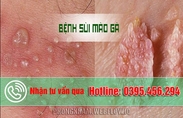 Dấu hiệu, triệu chứng bệnh sùi mào gà sau thời gian ủ bệnh
