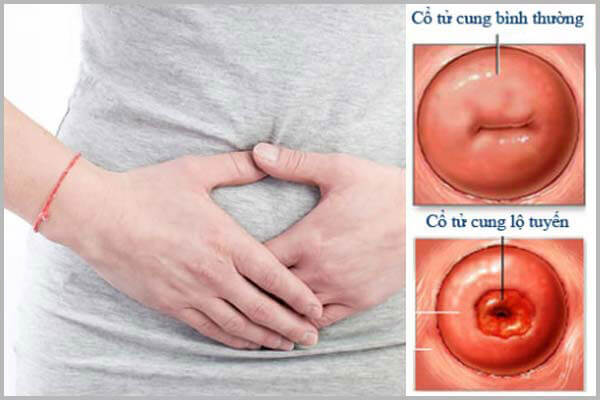 Tìm hiểu bệnh viêm lộ tuyến cổ tử cung là gì?