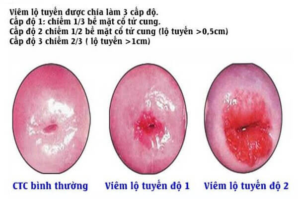 Phân biệt mức độ viêm lộ tuyến cổ tử cung 3, 2, 1