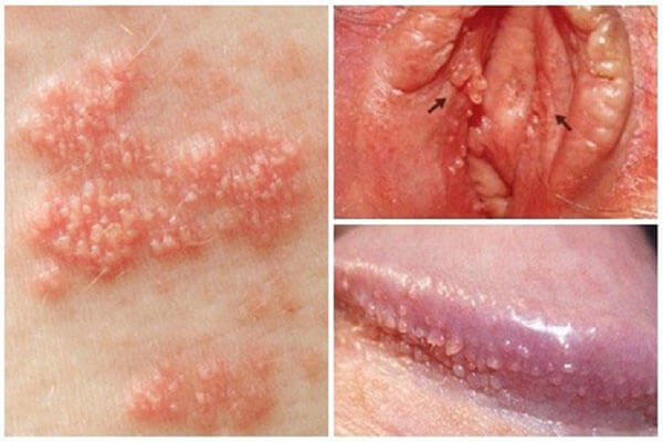 Blue waffle cảnh báo những bệnh xã hội nào?