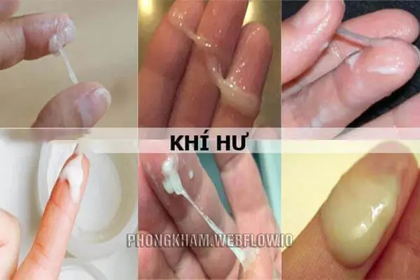 Vùng kín bị ngứa và có dịch trắng là bệnh gì?