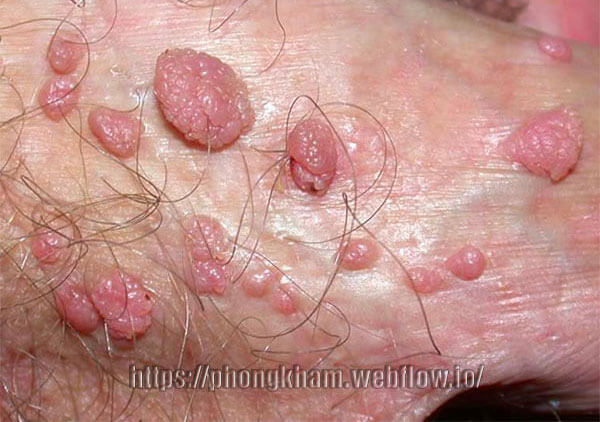 Sùi mào gà bệnh xã hội thường gặp nhất
