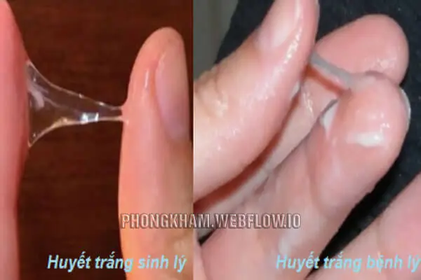 Cách chữa ra nhiều khí hư màu trắng trong hiệu quả