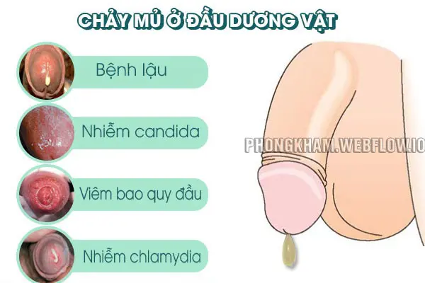 Dương vật chảy mủ có những biểu hiện triệu chứng nào?