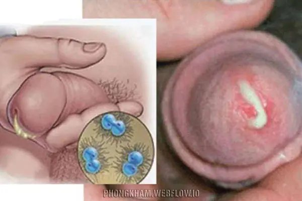 Cách điều trị dương vật chảy mủ như thế nào?