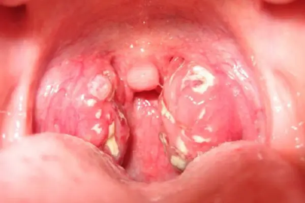 Hình ảnh mụn rộp sinh dục ở họng