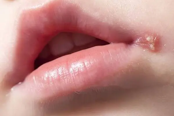 Hình ảnh mụn rộp sinh dục ở trẻ em
