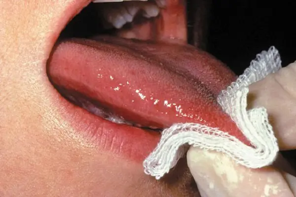 Hình ảnh mụn rộp sinh dục ở lưỡi