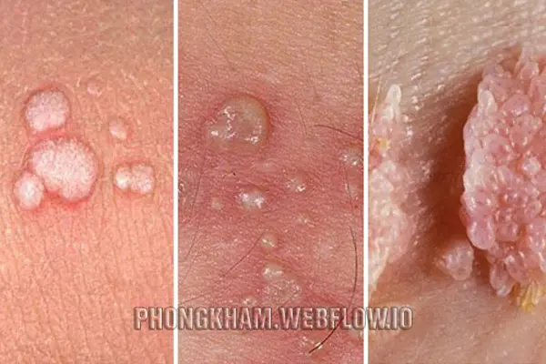 Thời gian ủ bệnh của sùi mào gà ở nam và nữ giới là bao lâu?