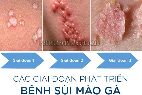 Thời gian ủ bệnh của sùi mào gà kéo dài trong bao lâu?