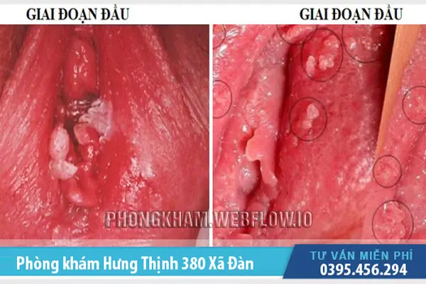 Các biện pháp phòng tránh triệu chứng trước và sau thời gian ủ bệnh sùi mào gà