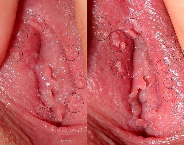 Bệnh sùi mào gà ở nữ biểu hiện, triệu chứng, nguy hiểm như thế nào?