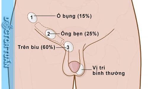 Tinh hoàn ẩn là gì? Có nguy hiểm không? Phẫu thuật ở đâu tốt?