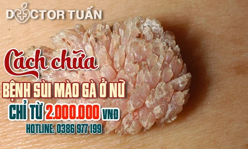 Tư vấn: Cách chữa bệnh sùi mào gà ở nữ triệt để ít tái phát