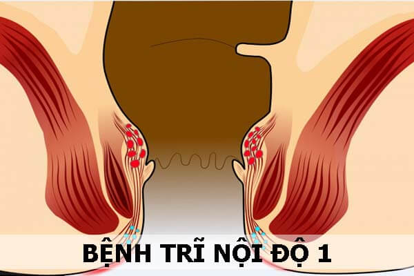 Bệnh trĩ nội độ 1: hình ảnh, hiện tượng cùng với biện pháp chữa