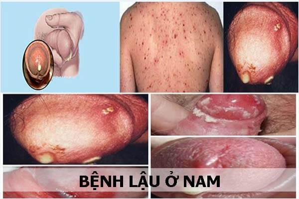 Biểu hiện Bệnh Lậu tại đàn ông, chị em và giải pháp điều trị