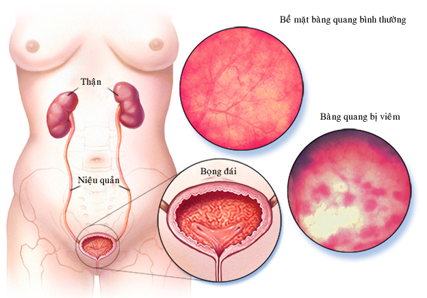 Xét nghiệm viêm bàng quang cần làm những gì ? Khám viêm bàng quang ở đâu ?