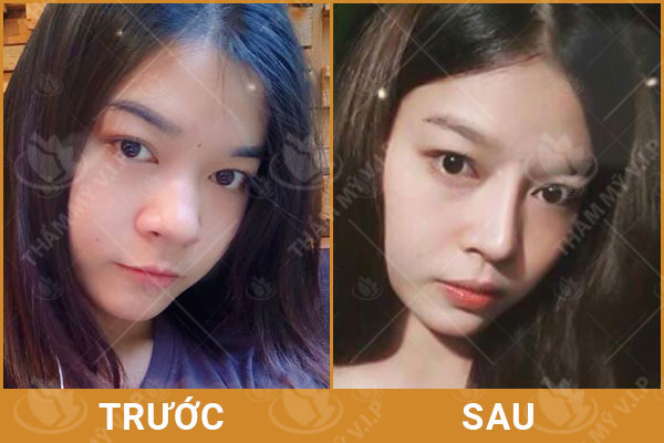 thu gọn cánh mũi