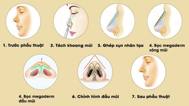 Nâng mũi bọc sụn megaderm là gì