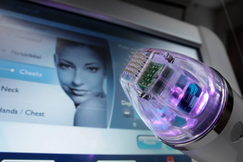RF Micro-Needling Device