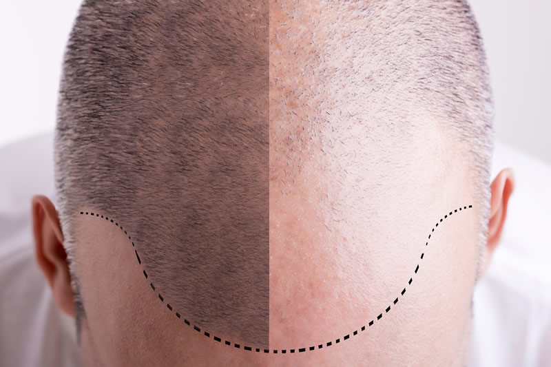 Hair Restoration