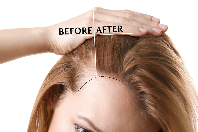 before and after Hair Restoration of female patient